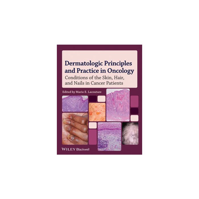 Dermatologic Principles and Practice in Oncology: Conditions of the Skin, Hair, and Nails in Cancer Patients Lacouture Mario E. Wiley - Blackwell 9780470621882 Dermatologic Principles and Practice in Oncology: Conditions of the Skin, Hair, and Nails in Cancer Patients Lacouture Mario E. Wiley - Blackwell 9780470621882
