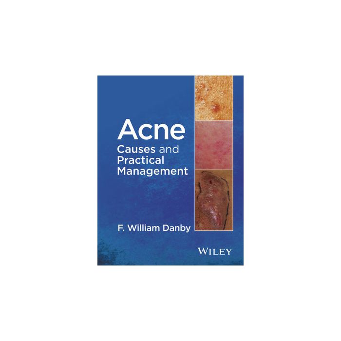 Acne: Causes and Practical Management Danby F. William Wiley - Blackwell 9781118232774 Acne: Causes and Practical Management Danby F. William Wiley - Blackwell 9781118232774