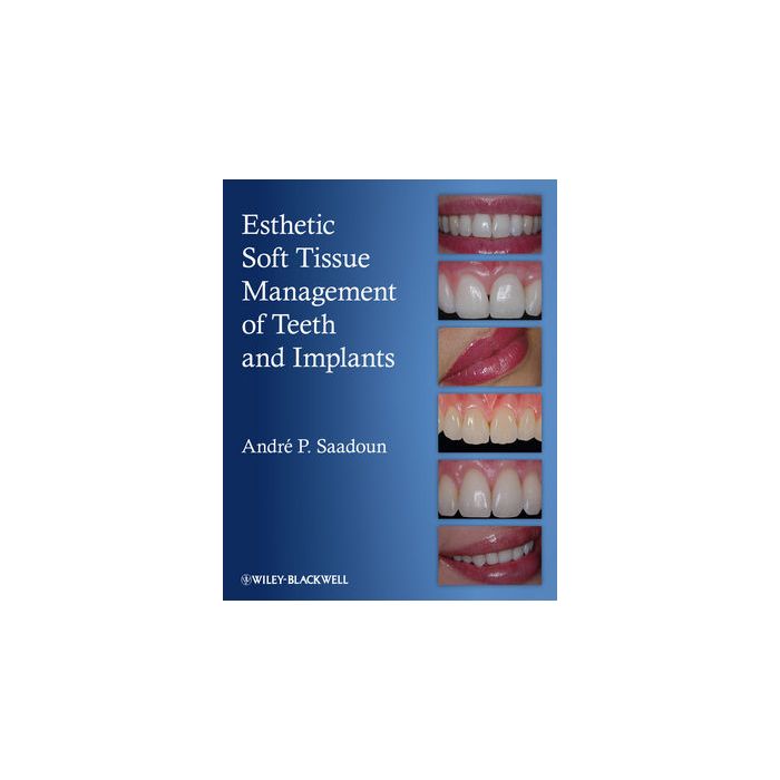 Esthetic Soft Tissue Management of Teeth and Implants Saadoun Andre P. Wiley - Blackwell 9781118301159 Esthetic Soft Tissue Management of Teeth and Implants Saadoun Andre P. Wiley - Blackwell 9781118301159