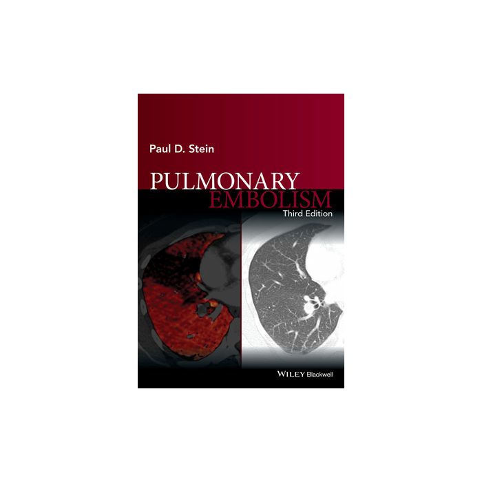 Pulmonary Embolism, 3ed. Stein Paul D. Wiley - Blackwell 9781119039082 Pulmonary Embolism, 3ed. Stein Paul D. Wiley - Blackwell 9781119039082