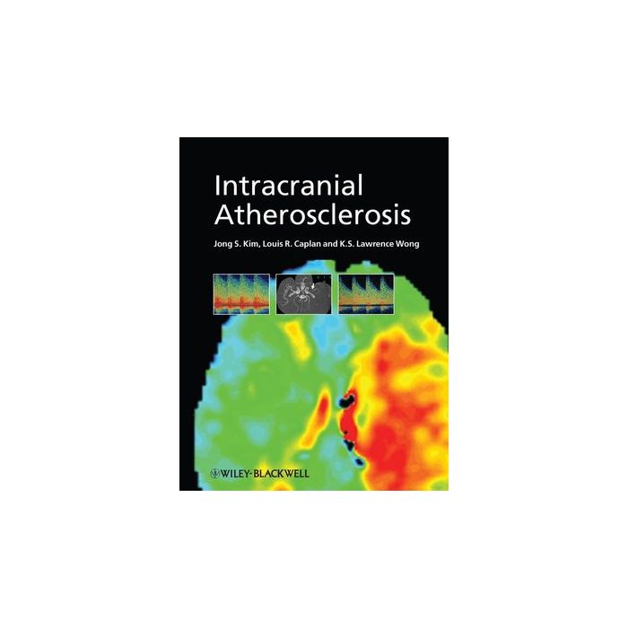 Intracranial Atherosclerosis  Kim Jong S.; Caplan Louis R.; Wong K. S. Lawrence  Wiley - Blackwell  9781405178228