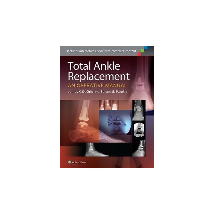 Total Ankle Replacement: An Operative Manual DeOrio James K.; Parekh Selene G. LIPPINCOTT Williams and Wilkins 9781451185225 Total Ankle Replacement: An Operative Manual DeOrio James K.; Parekh Selene G. LIPPINCOTT Williams and Wilkins 9781451185225