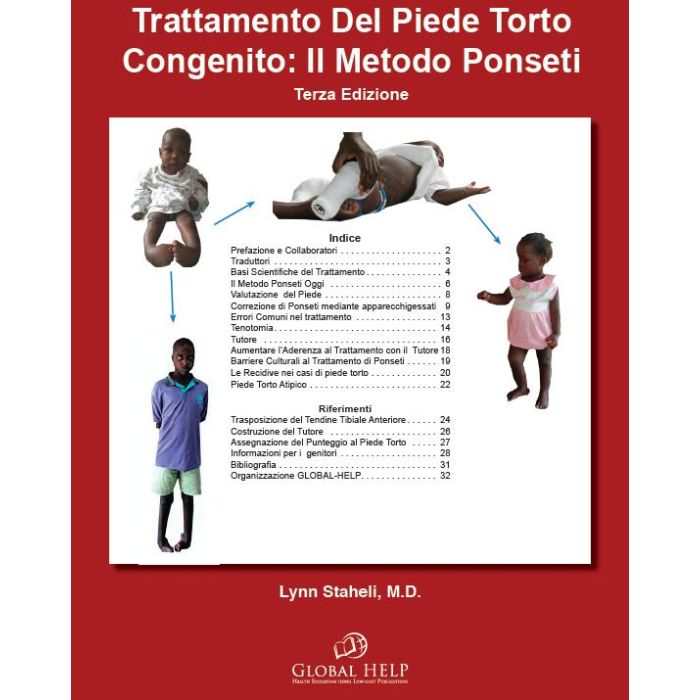 Trattamento del Piede Torto Congenito: Il metodo Ponseti Trattamento del Piede Torto Congenito: Il metodo Ponseti