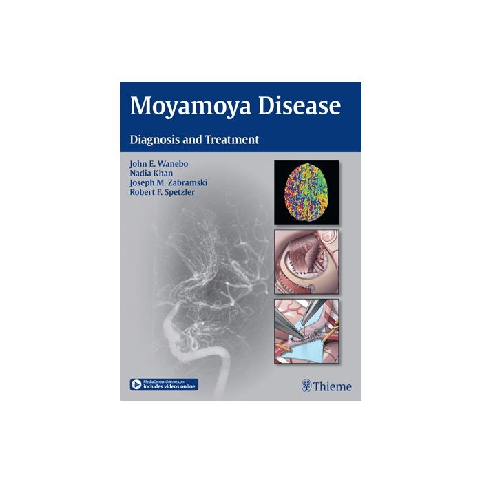 Moyamoya Disease. Diagnosis and Treatment Wanebo John E.; Khan Nadia; Zabramski Joseph M.; Spetzler Robert F. Thieme Medical Publishers 9781604067309 Moyamoya Disease. Diagnosis and Treatment Wanebo John E.; Khan Nadia; Zabramski Joseph M.; Spetzler Robert F. Thieme Medical Publishers 9781604067309