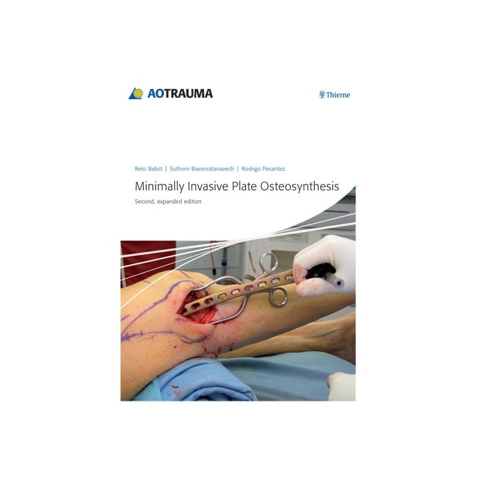Minimally Invasive Plate Osteosynthesis (MIPO)  Babst Reto; Bavonratanavech Suthorn; Pesantez Rodrigo F.  Thieme Medical Publishers  9783131433923