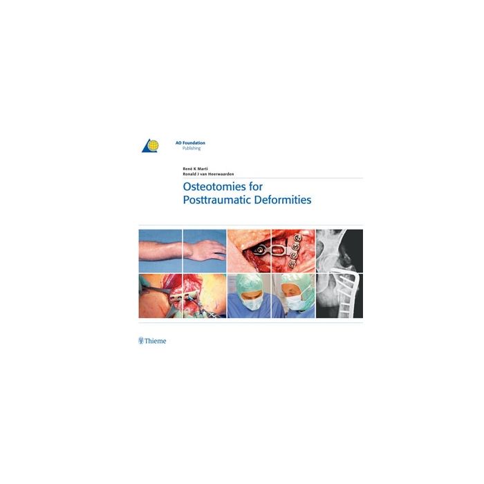 Osteotomies for Posttraumatic Deformities  Marti René K.; van Heerwaarden Ronald J.  Thieme Medical Publishers  9783131486714