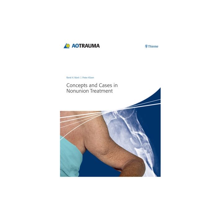 Concepts and Cases in Nonunion Treatment Marti René K.; Kloen Peter Thieme Medical Publishers 9783131658517 Concepts and Cases in Nonunion Treatment Marti René K.; Kloen Peter Thieme Medical Publishers 9783131658517