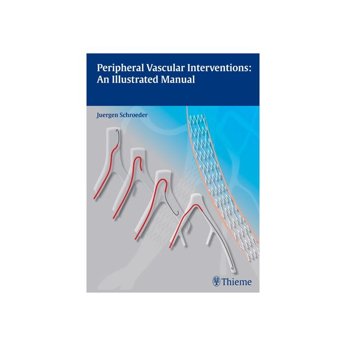 Peripheral Vascular Interventions: An Illustrated Manual Schroeder Juergen Thieme Medical Publishers 9783131697516 Peripheral Vascular Interventions: An Illustrated Manual Schroeder Juergen Thieme Medical Publishers 9783131697516