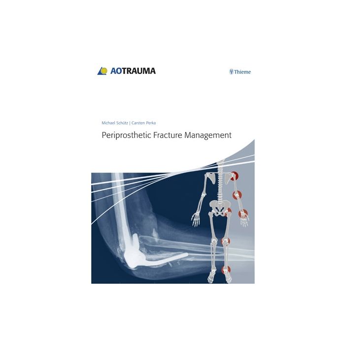 Periprosthetic Fracture Management  Schuetz Michael; Perka Carsten  Thieme Medical Publishers  9783131715111