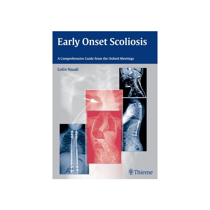 Early Onset Scoliosis. A Comprehensive Guide from the Oxford Meetings  Nnadi Colin  Thieme Medical Publishers  9783131726612