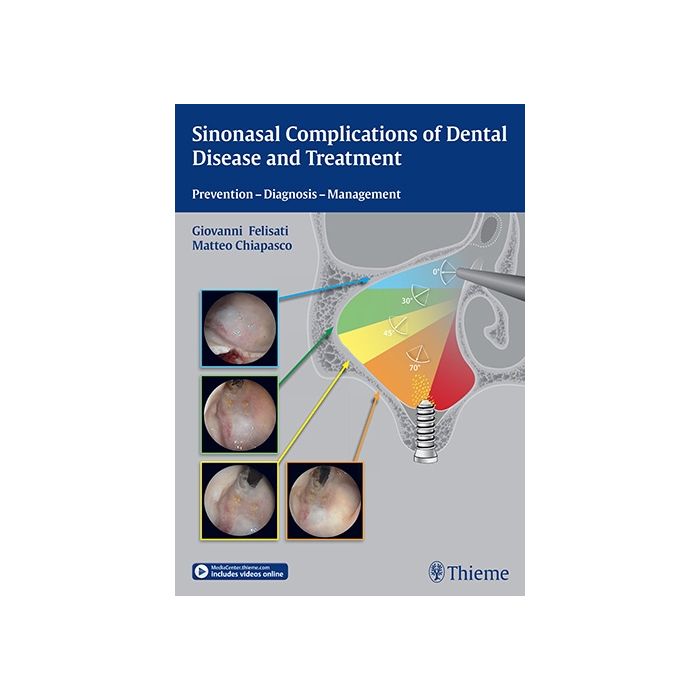 Sinonasal Complications of Dental Disease and Treatment. Prevention, Diagnosis, Management  Felisati Giovanni; Chiapsco Matteo  Thieme Medical Publishers  9783131997012