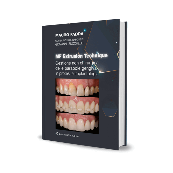 Mauro Fadda Giovanni Zucchelli mf extrusion technique gestione non chirurgica delle parabole gengivali in protesi e implantologia quintessenza Mauro Fadda Giovanni Zucchelli mf extrusion technique gestione non chirurgica delle parabole gengivali in protesi e implantologia quintessenza