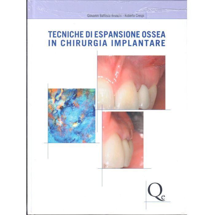 Tecniche di espansione ossea in chirurgia implantare  [Bruschi - Quintessenza Edizioni]