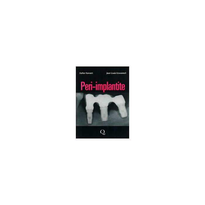 Peri - Implantite  [Corigliano; Baldoni - Quintessenza Edizioni] 9788874921935