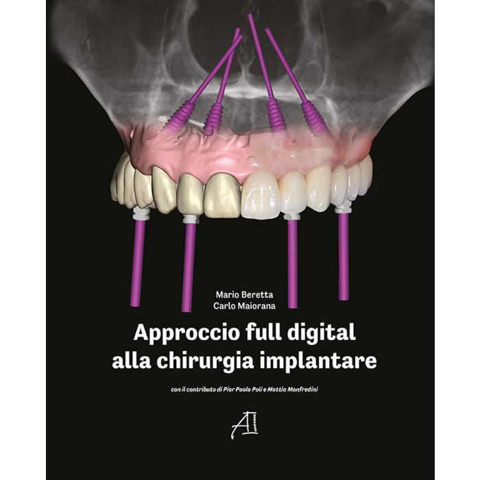 Approccio ful digital alla chirurgia implantare mario beretta carlo maiorana ariesdue edizioni libro Approccio ful digital alla chirurgia implantare mario beretta carlo maiorana ariesdue edizioni libro