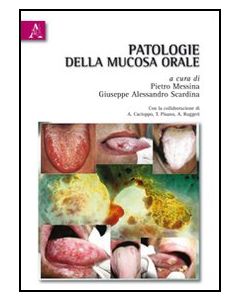 Patologie Della Mucosa Orale - Messina Pietro; Scardina Giuseppe A. - Aracne - 9788854833975