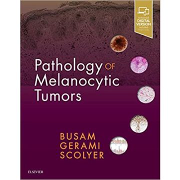Pathology of Melanocytic Tumors