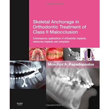 Skeletal Anchorage in Orthodontic Treatment of Class II Malocclusion - Contemporary applications of orthodontic implants, miniscrew implantsand mini plates   [Papadopoulos - Elsevier Science]   
