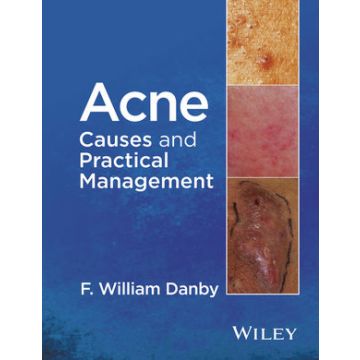 Acne: Causes and Practical Management  Danby F. William  Wiley - Blackwell  9781118232774