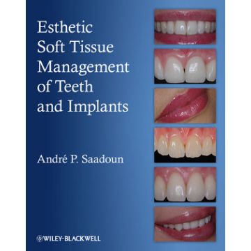 Esthetic Soft Tissue Management of Teeth and Implants  Saadoun Andre P.  Wiley - Blackwell  9781118301159