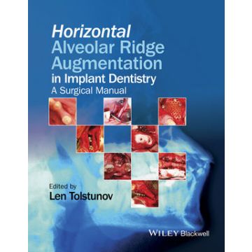 Horizontal Alveolar Ridge Augmentation in Implant Dentistry: A Surgical Manual  Tolstunov Len  Wiley - Blackwell   9781119019886
