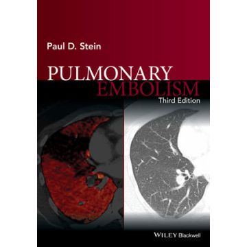 Pulmonary Embolism, 3ed.  Stein Paul D.  Wiley - Blackwell  9781119039082