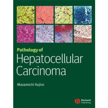 Pathology of Hepatocellular Carcinoma  Kojiro Masamichi  Wiley - Blackwell  9781405139083