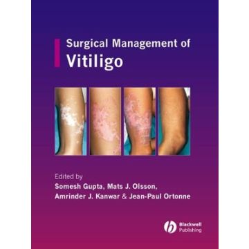 Surgical Management of Vitiligo  Gupta Somesh; Olsson Mats J.; Kanwar Amrinder J.; Ortonne Jean-Paul  Wiley - Blackwell  9781405145213