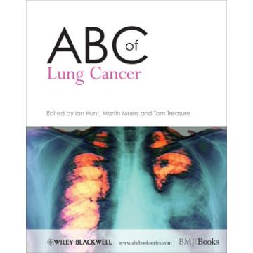 ABC of Lung Cancer  Hunt Ian; Muers Martin M.; Treasure Tom  Wiley - Blackwell  9781405146524