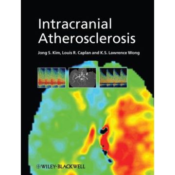 Intracranial Atherosclerosis  Kim Jong S.; Caplan Louis R.; Wong K. S. Lawrence  Wiley - Blackwell  9781405178228