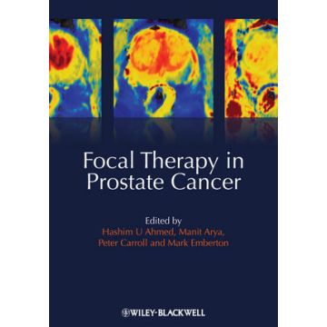 Focal Therapy in Prostate Cancer  Ahmed Hashim Uddin; Arya Manit; Carroll Peter R.; Emberton Mark  Wiley - Blackwell  9781405196499