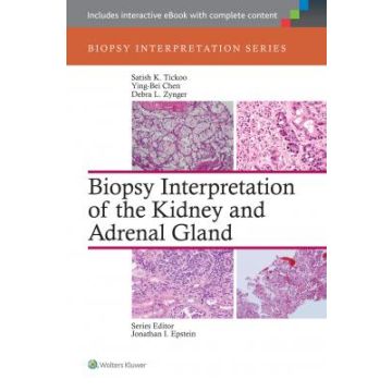 Biopsy Interpretation of the Kidney & Adrenal Gland  Tickoo Satish; Chen Ying-bei; Zynger Debra  LIPPINCOTT Williams and Wilkins  9781451176476