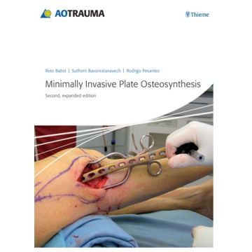 Minimally Invasive Plate Osteosynthesis (MIPO)  Babst Reto; Bavonratanavech Suthorn; Pesantez Rodrigo F.  Thieme Medical Publishers  9783131433923