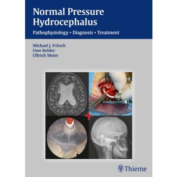 NPH - Normal Pressure Hydrocephalus. Pathophysiology - Diagnosis - Treatment  Fritsch Michael J.; Kehler Uwe; Meier Ullrich  Thieme Medical Publishers  9783131646019