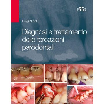 Diagnosi e trattamento delle forcazioni parodontali Luigi Nibali Edra