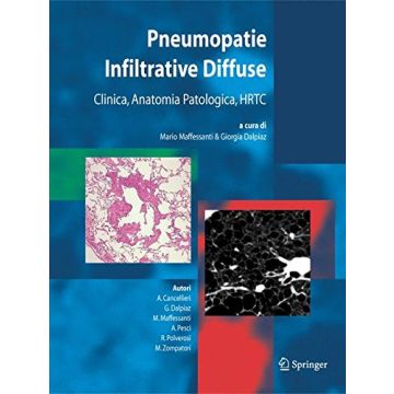 Maffessanti Pneumopatie Infiltrative Diffuse Springer