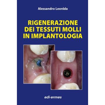 Rigenerazione dei tessuti molli in implantologia    [Leonida - Edi Ermes]