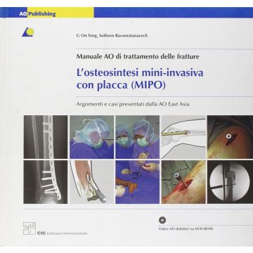 L'Osteosintesi Mini-Invasiva con placca MIPO Manuale AO di trattamento delle fratture