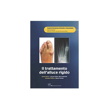 Il trattamento dell'alluce rigido  AA.VV.  CIC Edizioni Internazionali  9788871419909