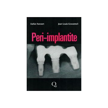 Peri - Implantite  [Corigliano; Baldoni - Quintessenza Edizioni] 9788874921935