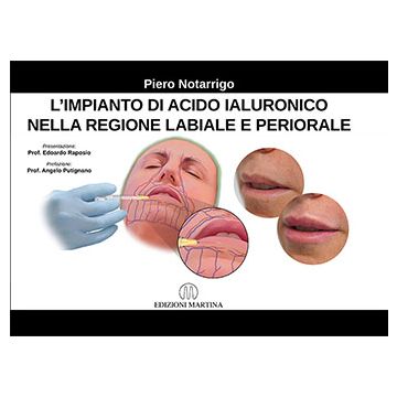 L'Impianto di acido ialuronico nella regione labiale e periorale  [Notarrigo - Martina Edizioni]