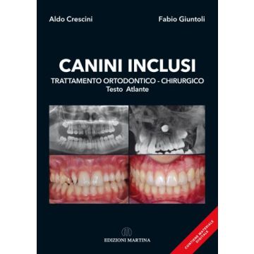 Canini Inclusi. Trattamento Ortodontico-Chirurgico – Testo Atlante