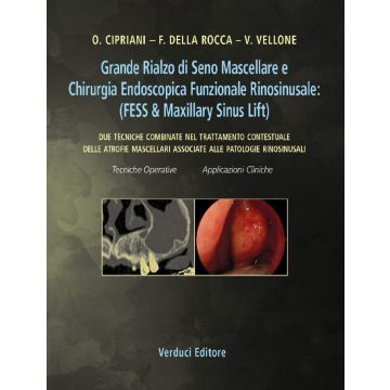 Grande Rialzo di Seno Mascellare e Chirurgia Endoscopica Funzionale Rinosinusale: (FESS Due tecniche combinate nel trattamento contestuale delle atrofie mascellari associate alle patologie rinosinusali