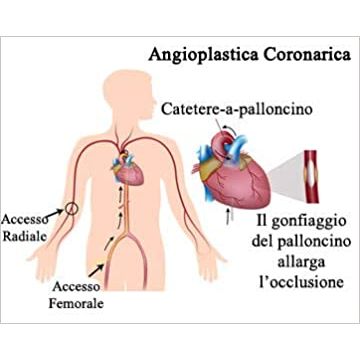 Stent vascolari