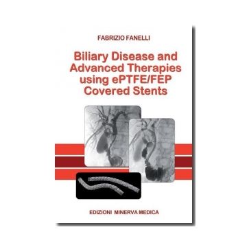 Biliary disease and advanced therapies using ePTFE/FEP covered stents