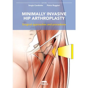 Minimally invasive hip arthroplasty. Surgical approaches and procedures