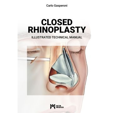 Closed rhinoplasty. Illustrated technical manual
