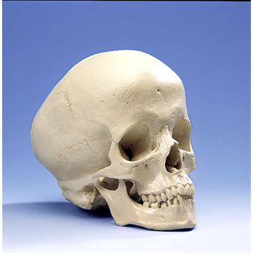 Cranio idrocefalo