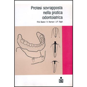 Protesi sovrapposta nella pratica odontoiatrica