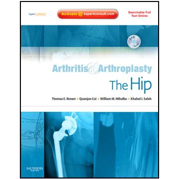 Arthritis and Arthroplasty: The Hip - Expert Consult - Online, Print and DVD
